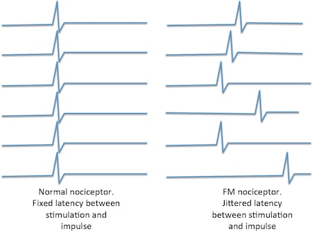 normal-and-FM-nociceptor