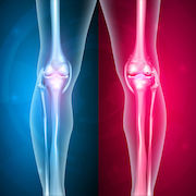 Normal leg knee joint at the blue background and unhealthy joint at the red background